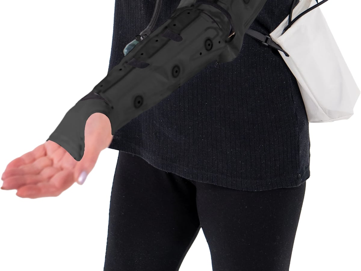A patient fitted with a compression arm garment